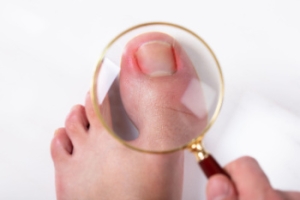 What to Do With an Ingrown Toenail