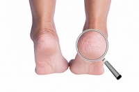 Can Children Have Cracked Heels?