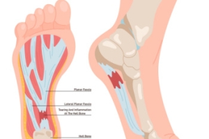 Understanding Plantar Fasciitis