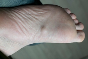 Plantar Fibromas Cause Foot Lumps