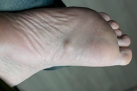 Plantar Fibromas Cause Foot Lumps