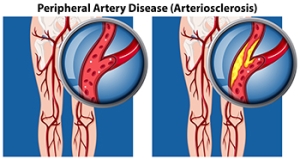 Understanding Peripheral Arterial Disease
