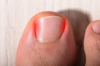 When an Ingrown Toenail Becomes Dangerous